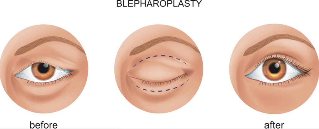 Recovering from Eyelid Surgery: What You Can Expect After a Blepharoplasty